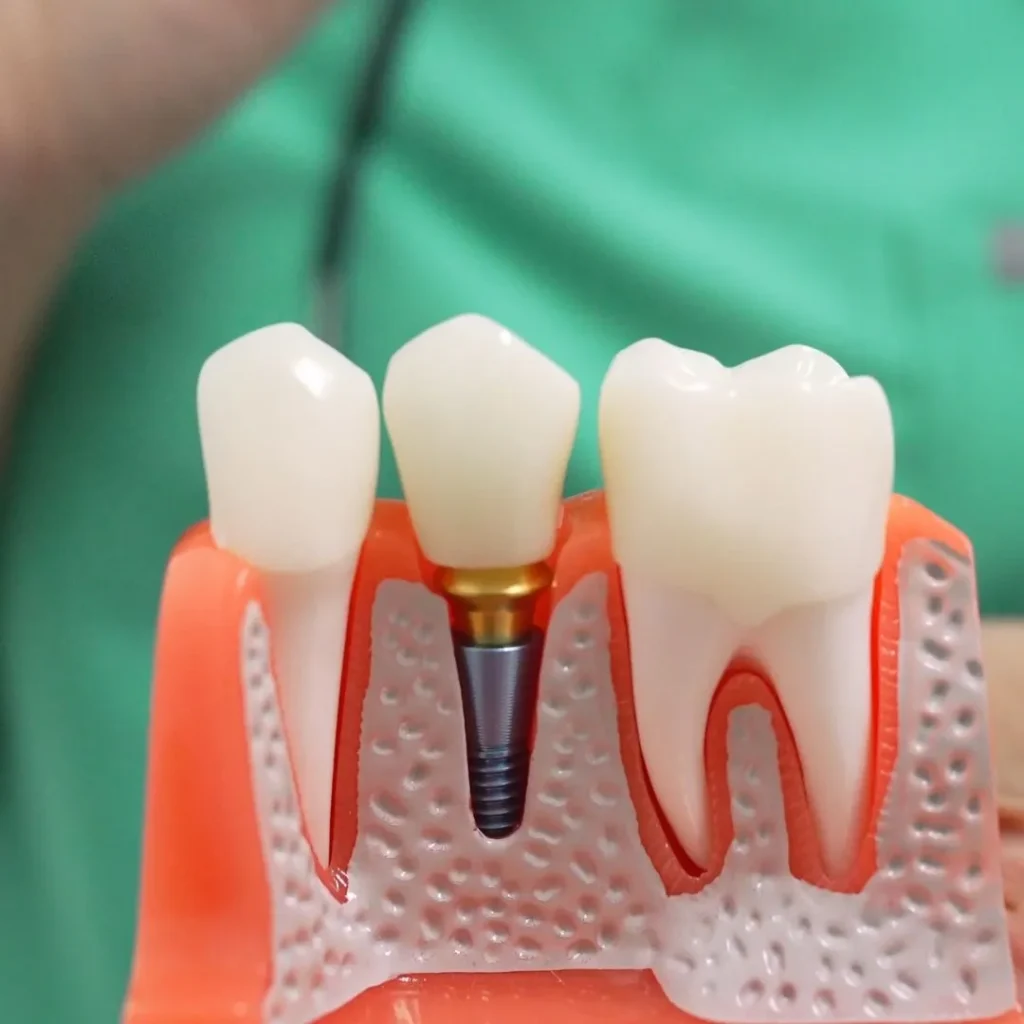 Dental implants in Vauxhall London