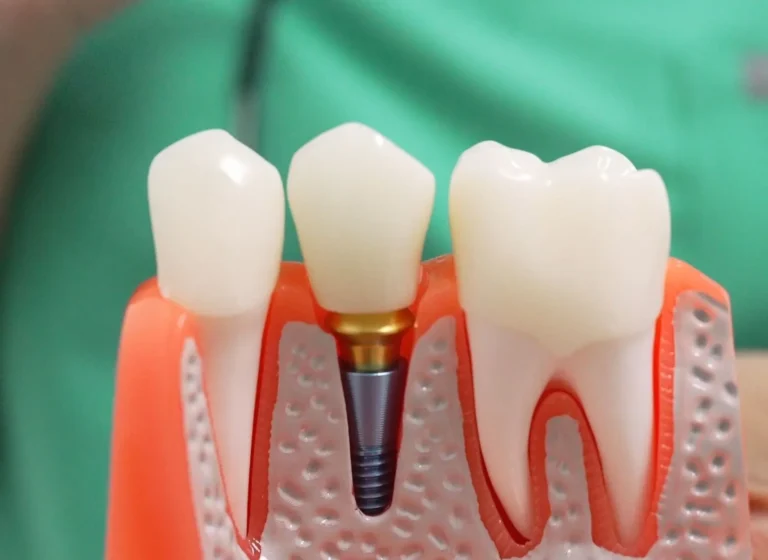 Blog 6 What Are Dental Implants