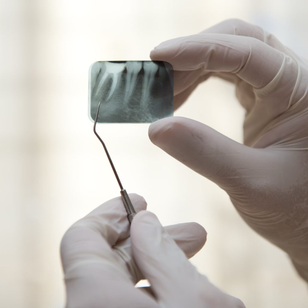 Endodontics 1 Root canal in Vauxhall London