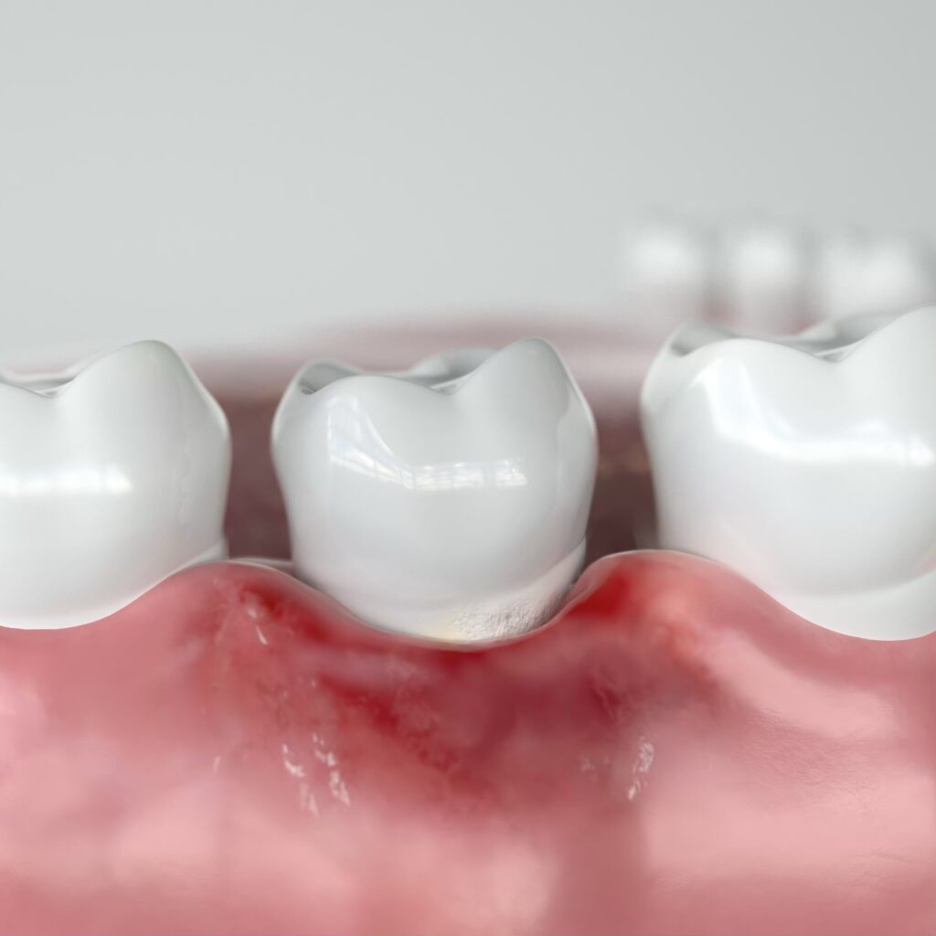 Periodontology 1 Treating gum disease in Vauxhall London