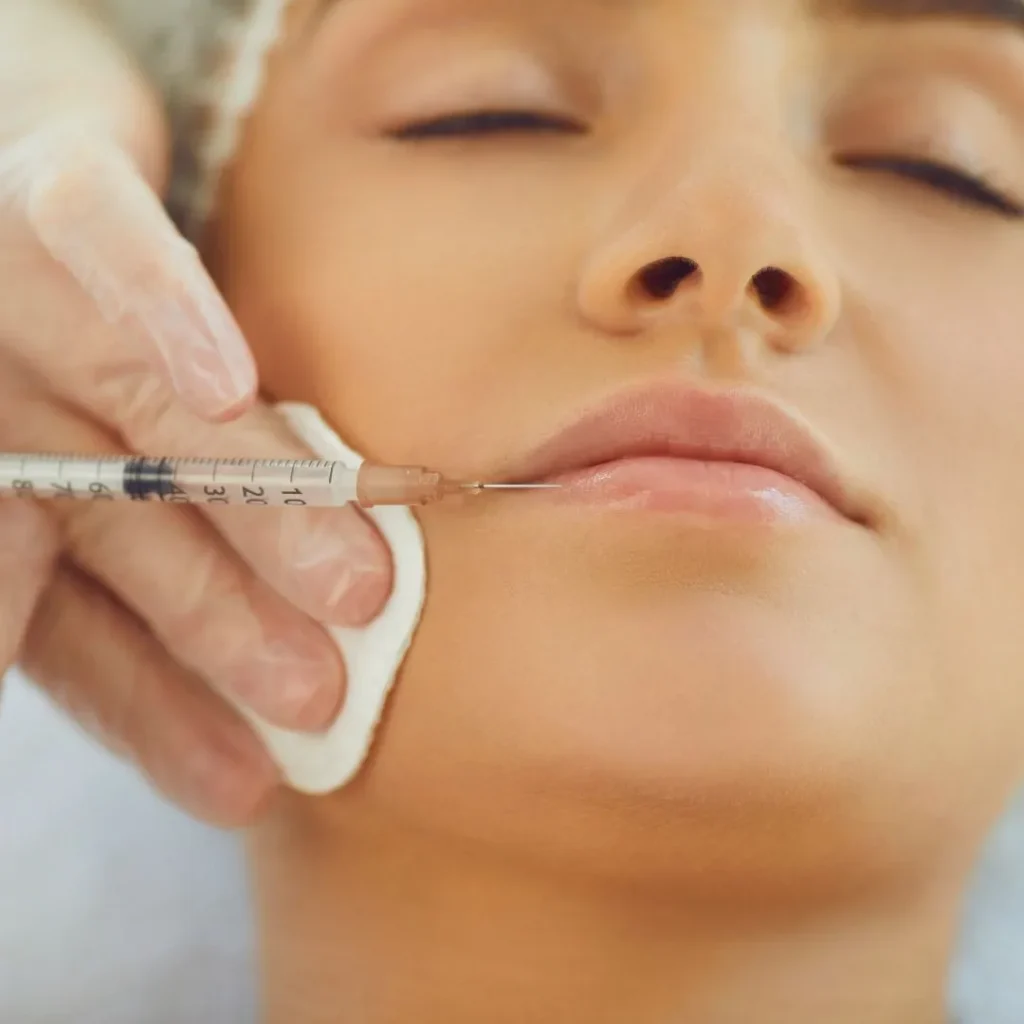 Aesthetic Medicine 1 Lip filler in Vauxhall London