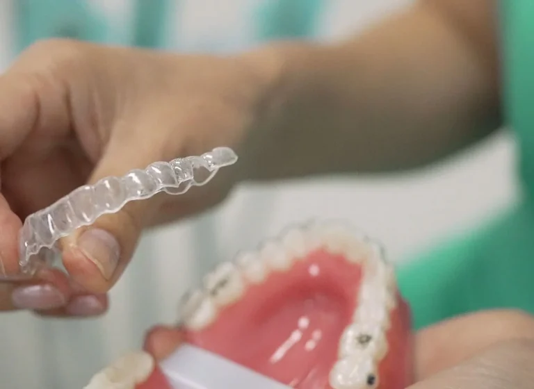 Blog 5 how much are clear braces