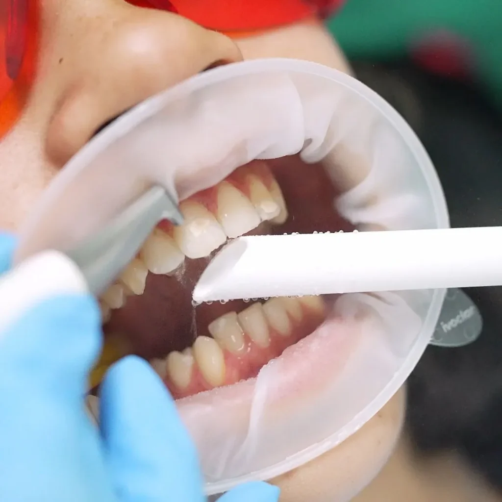 Oral Hygiene 5 Teeth cleaning in Vauxhall London