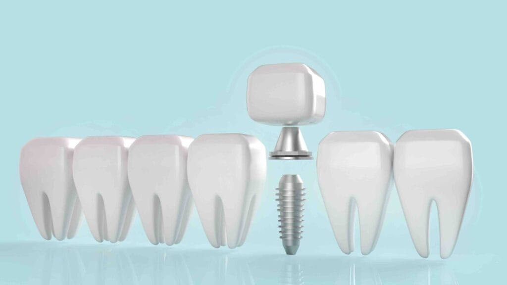 Complete guide to implantology